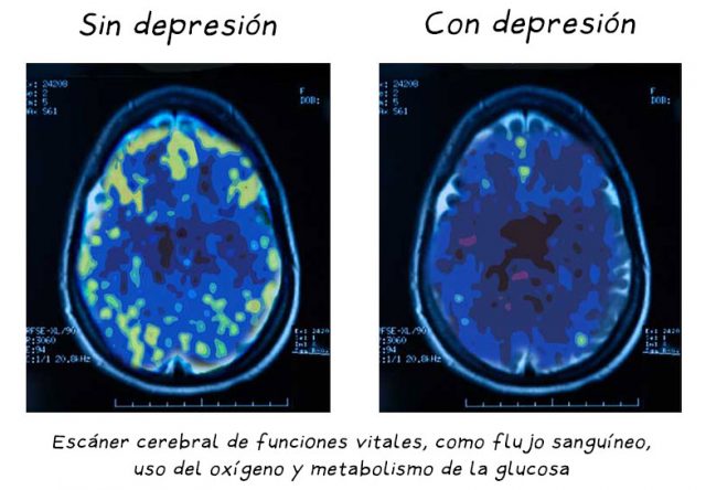 cerebro con depresión y sin depresión, escáner encefálico, muestra cómo en el cerebro deprimido disminuyen las funciones metabólicas, de flujo sanguíneo, oxigenación y metabolismo de la glucosa.